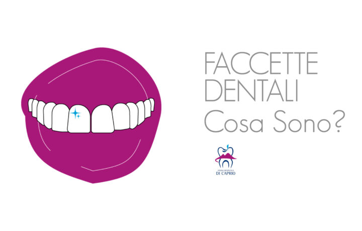 Cosa Sono le Faccette Dentali? Dentista Napoli Di Caprio
