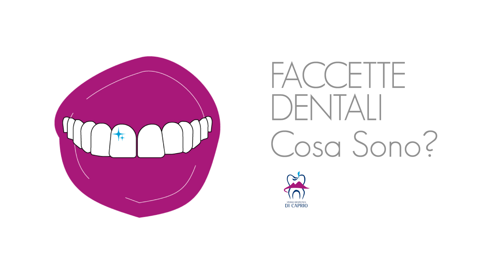 Cosa Sono le Faccette Dentali? Dentista Napoli Di Caprio