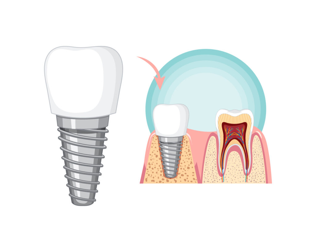 Impianti Dentali Napoli