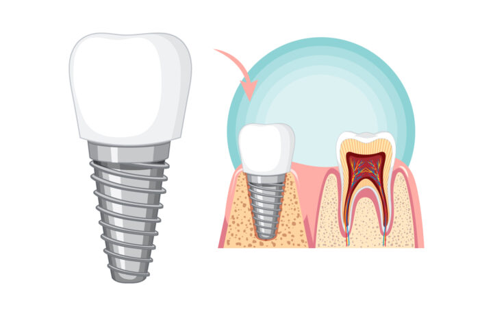 Impianti Dentali Napoli