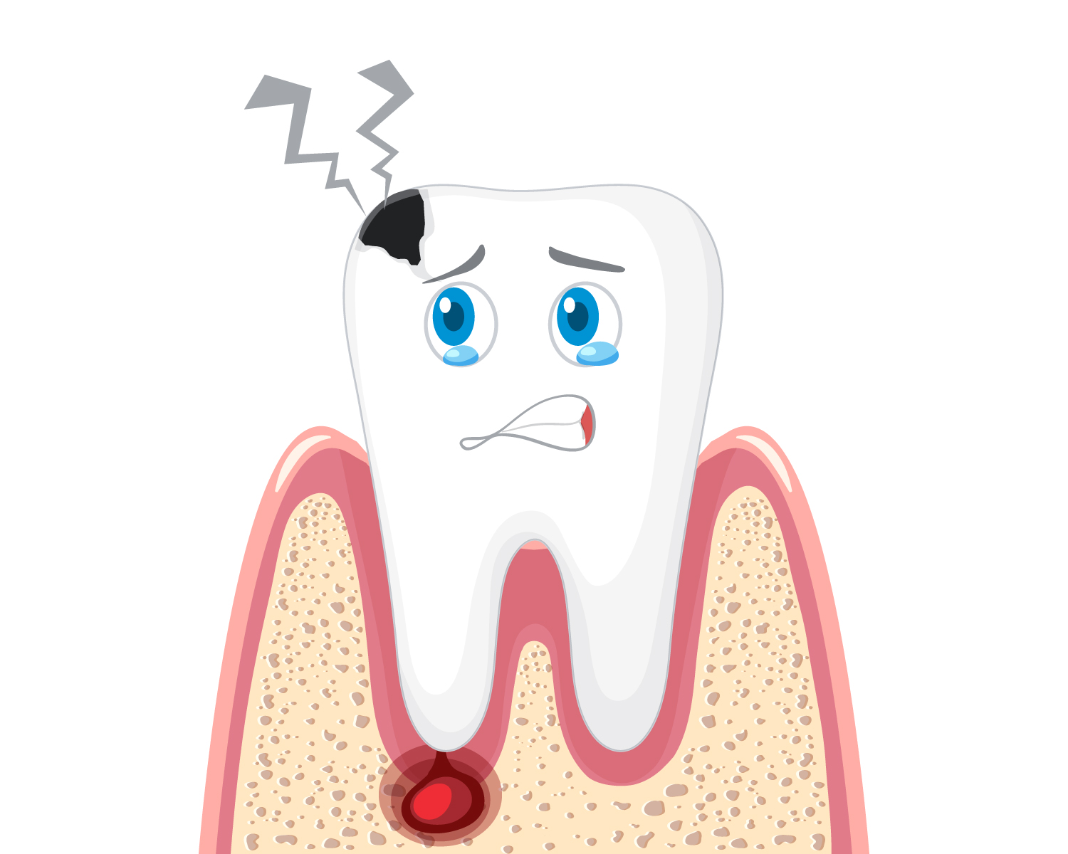 Dentista Napoli. La Carie Dentaria. Come curarla.