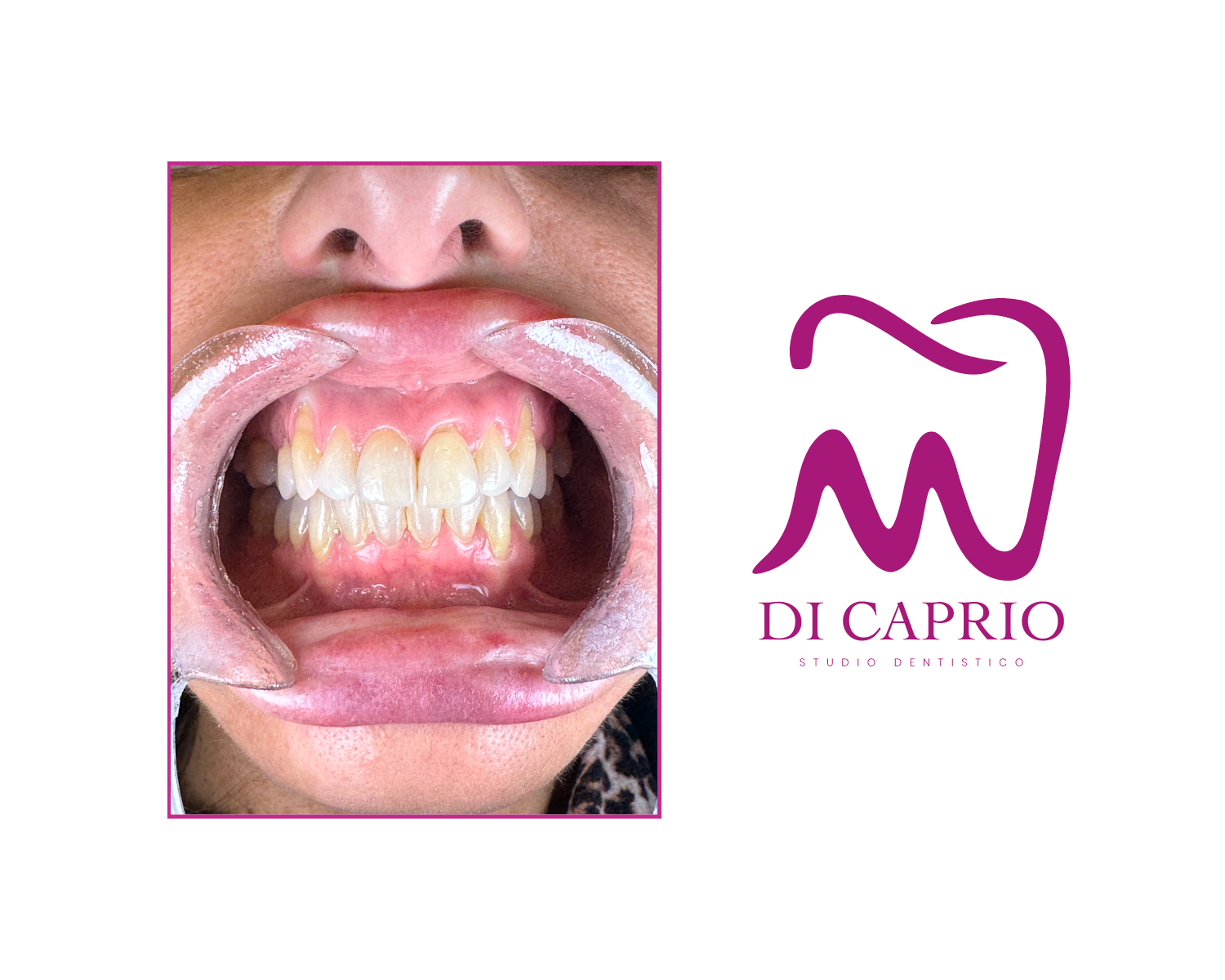 Dentista a Napoli - Recessione Gengivale