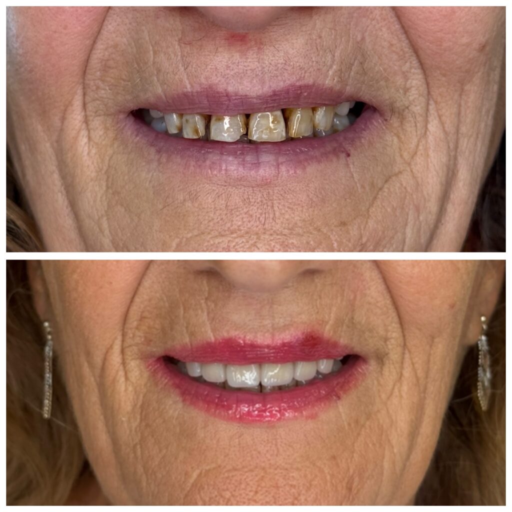 Faccette Dentali.