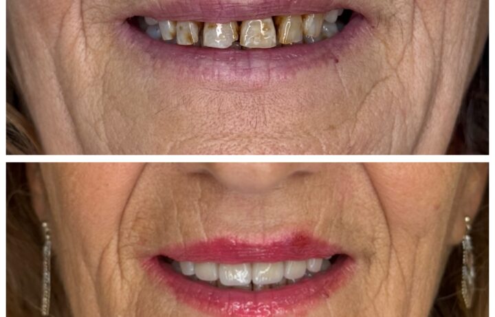 Faccette Dentali.