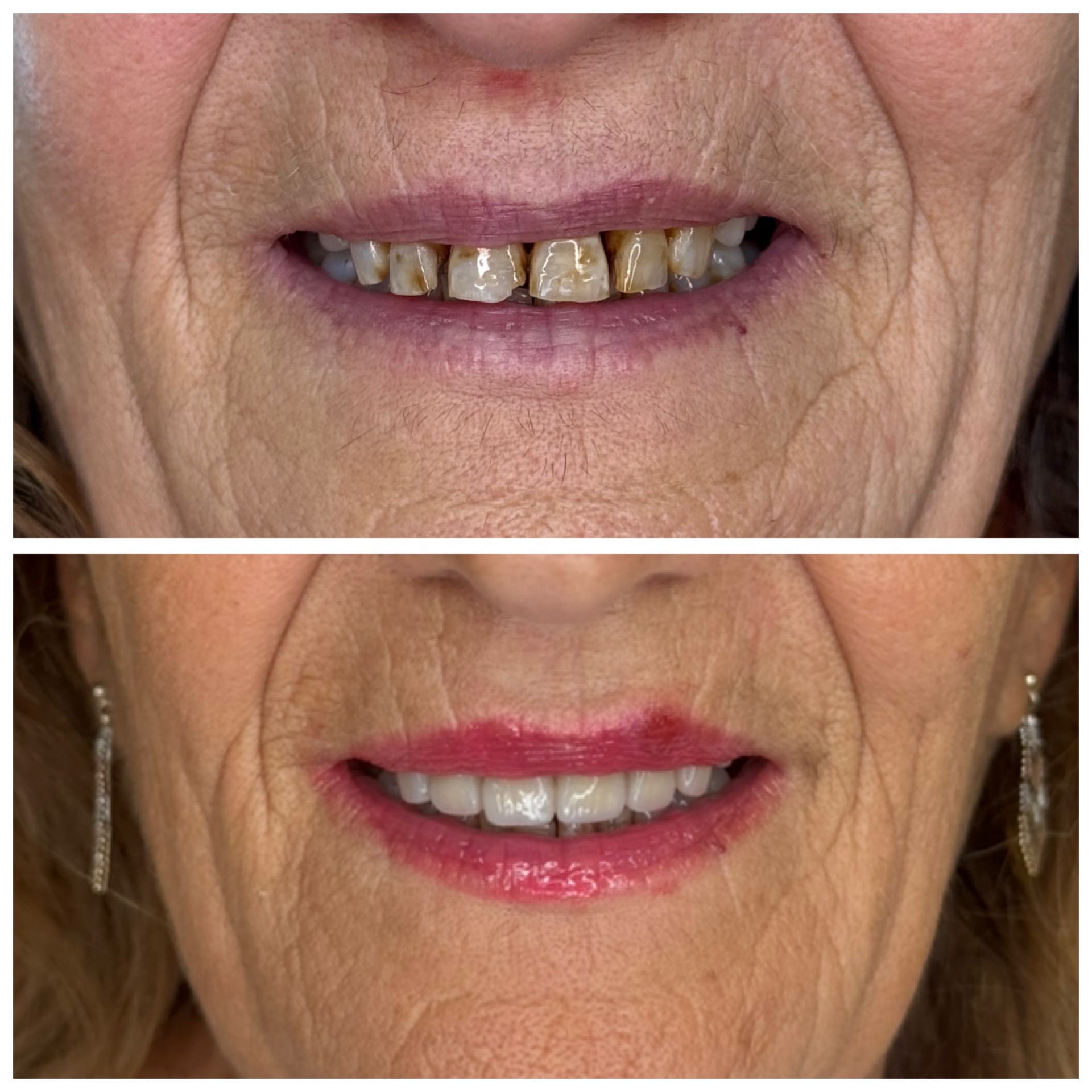 Faccette Dentali.