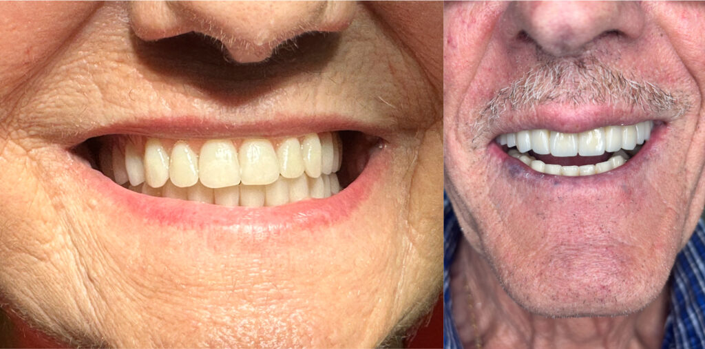 Protesi-Rimovibile-e-Protesi-Fissa---Studio-Dentistico-Di-Caprio-