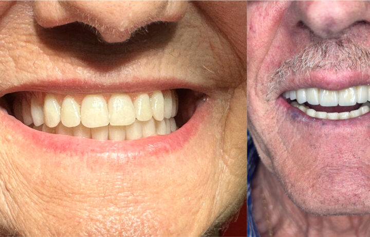 Protesi-Rimovibile-e-Protesi-Fissa---Studio-Dentistico-Di-Caprio-