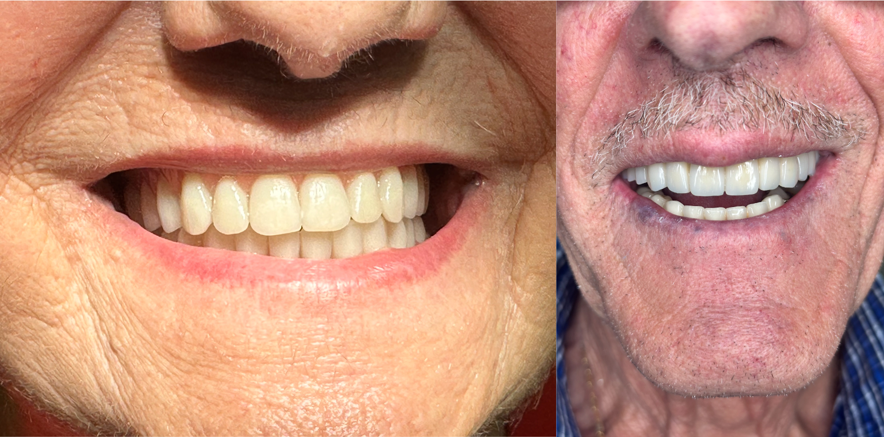 Protesi-Rimovibile-e-Protesi-Fissa---Studio-Dentistico-Di-Caprio-