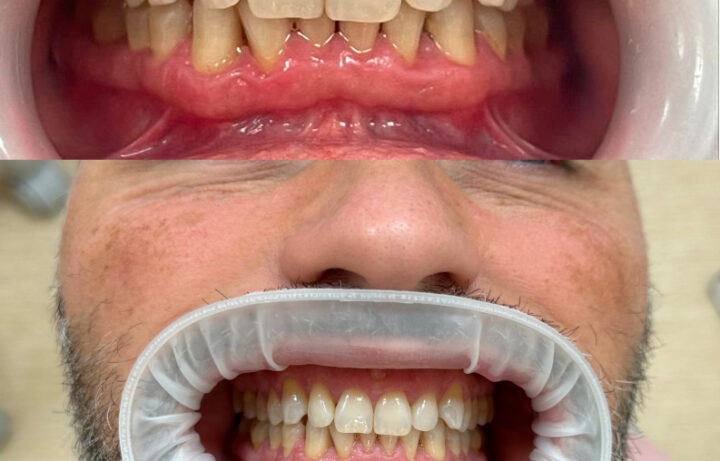 Chirurgia Parodontale: Può Eliminare Definitivamente la Parodontite?