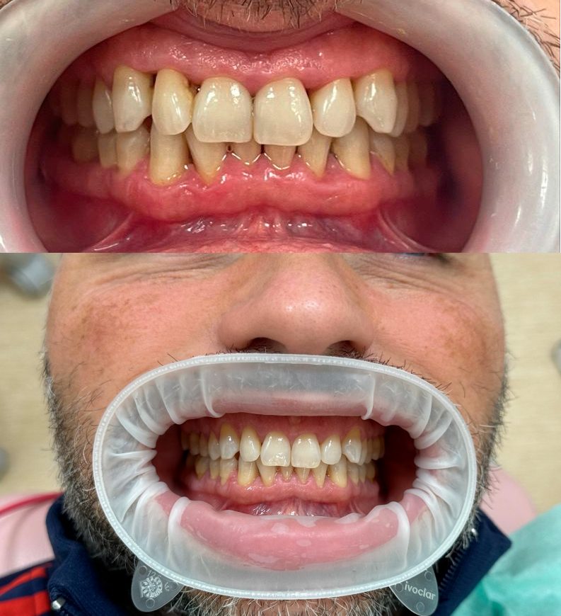 Chirurgia Parodontale: Può Eliminare Definitivamente la Parodontite?