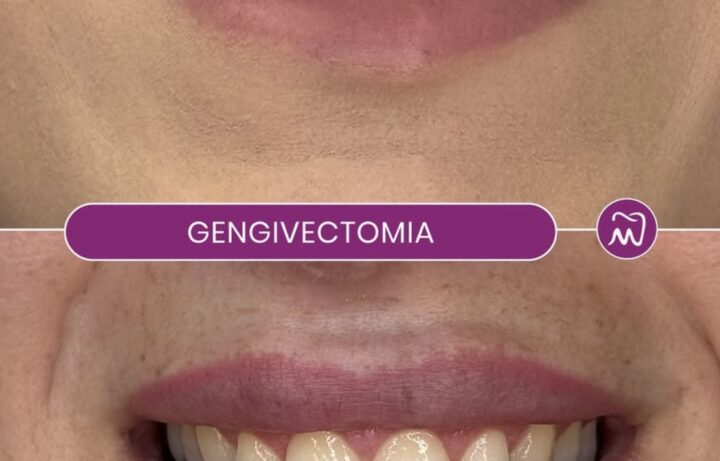 Sorriso Gengivale - Dentista Napoli