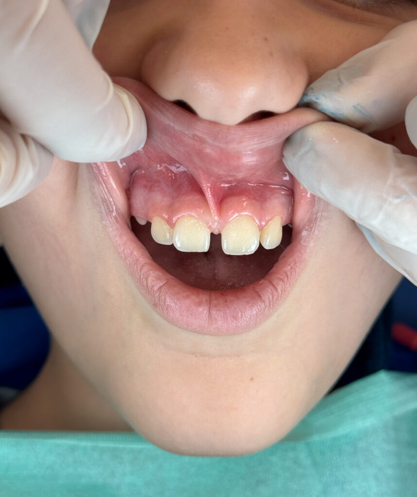 Frenulectomia laser per la correzione del frenulo labiale superiore nello studio dentistico a Napoli