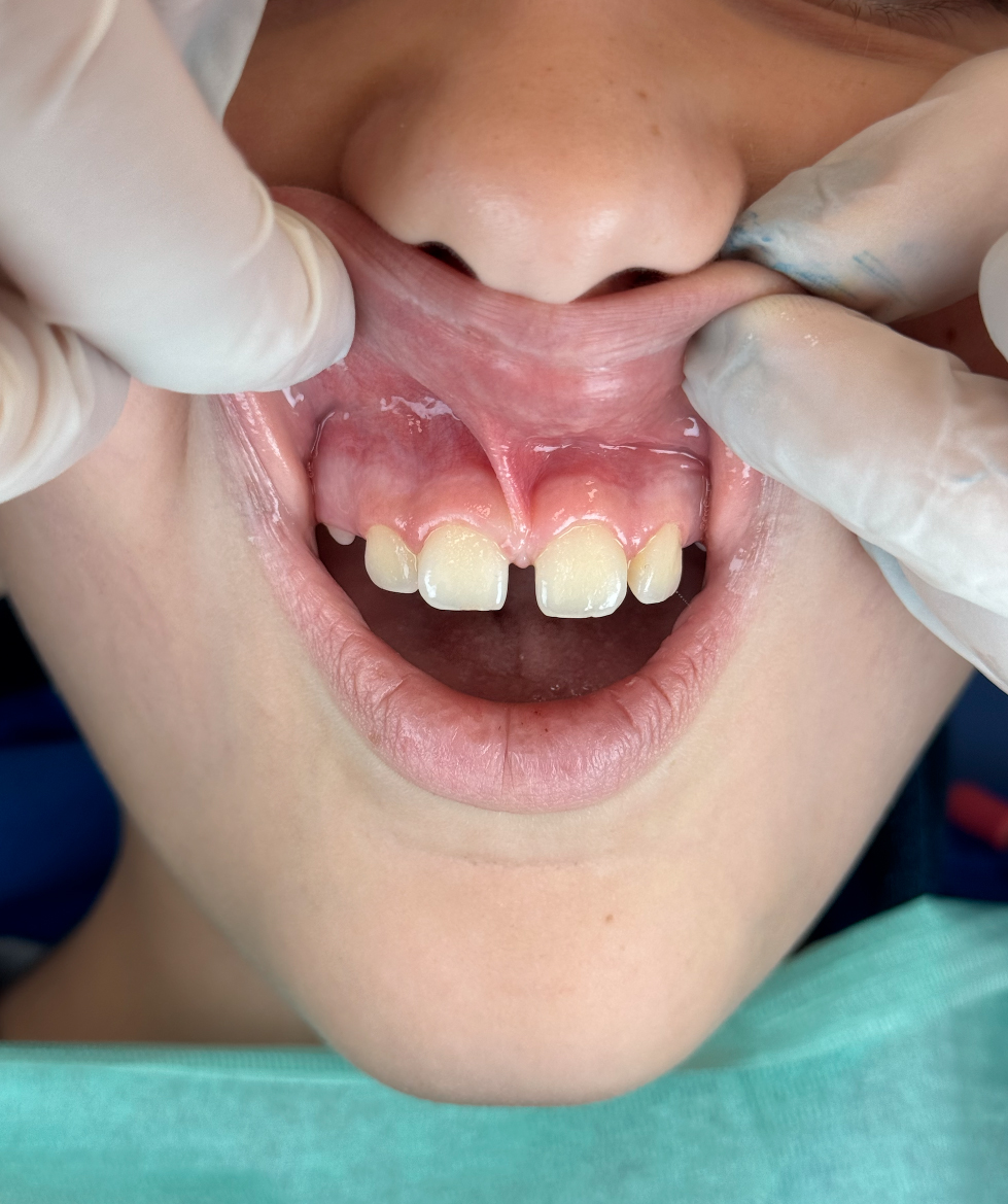 Frenulectomia laser per la correzione del frenulo labiale superiore nello studio dentistico a Napoli