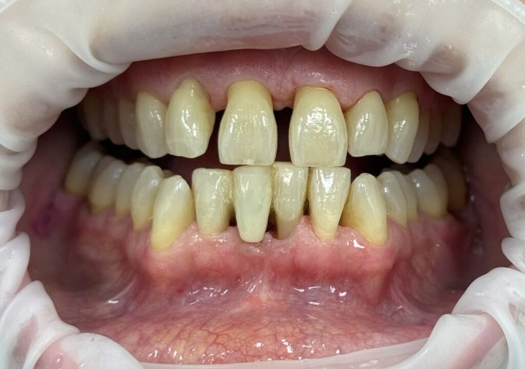 Parodontite avanzata gengive infiammate e recessione gengivale. Cura Parodontite a Napoli