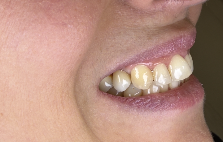 Denti naturali con discromie e gengiva visibile, esempio clinico per valutare un impianto dentale a Napoli Vomero o trattamenti conservativi