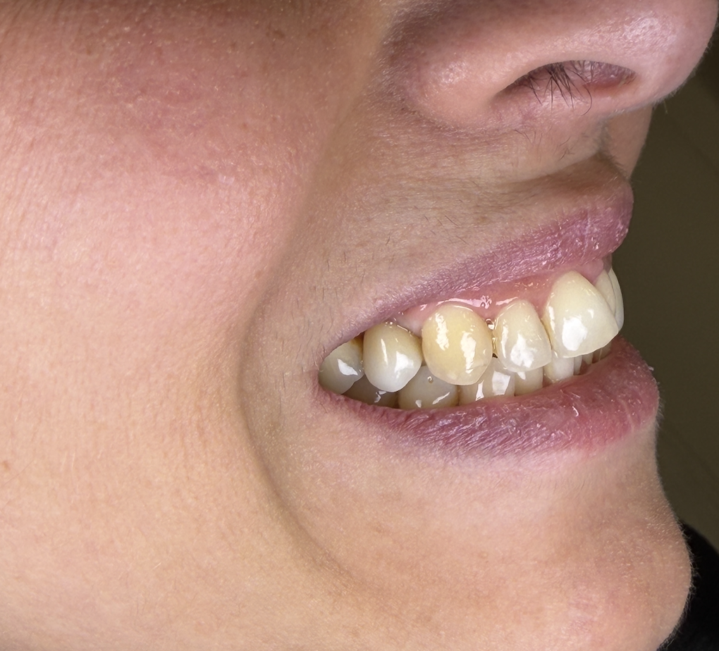 Denti naturali con discromie e gengiva visibile, esempio clinico per valutare un impianto dentale a Napoli Vomero o trattamenti conservativi