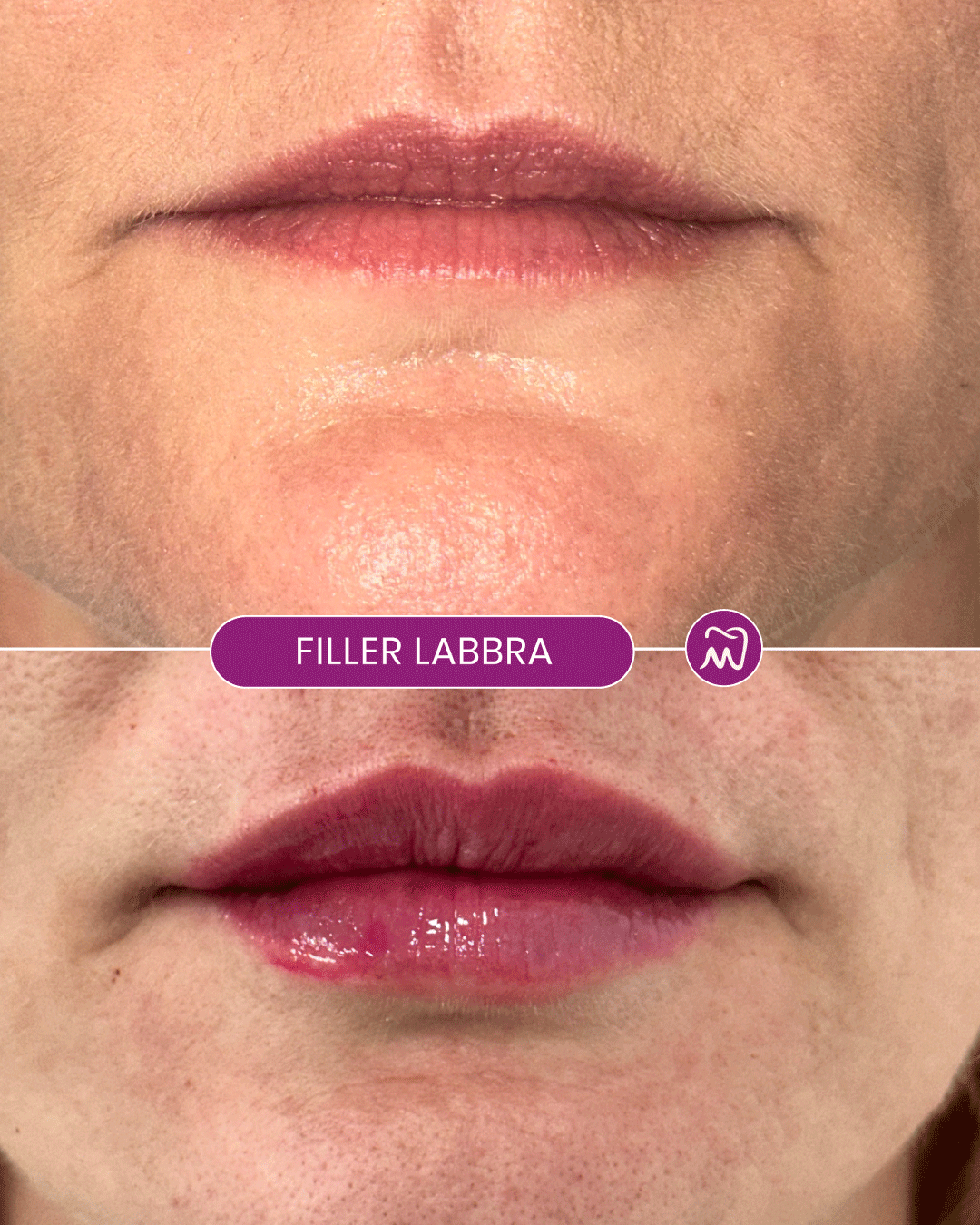 Prima e dopo trattamento filler labbra per aumentare volume, definizione e armonia del viso
