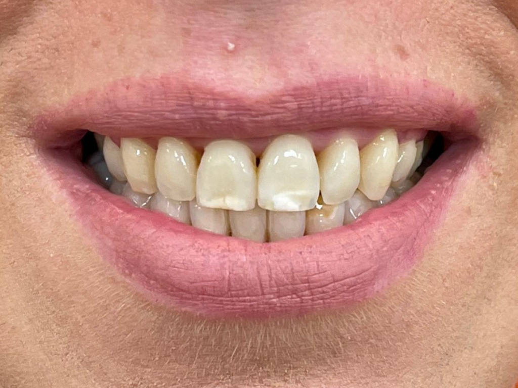 Paziente con macchie bianche sullo smalto dei denti prima del trattamento estetico dentale a Napoli Vomero