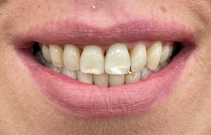 Paziente con macchie bianche sullo smalto dei denti prima del trattamento estetico dentale a Napoli Vomero