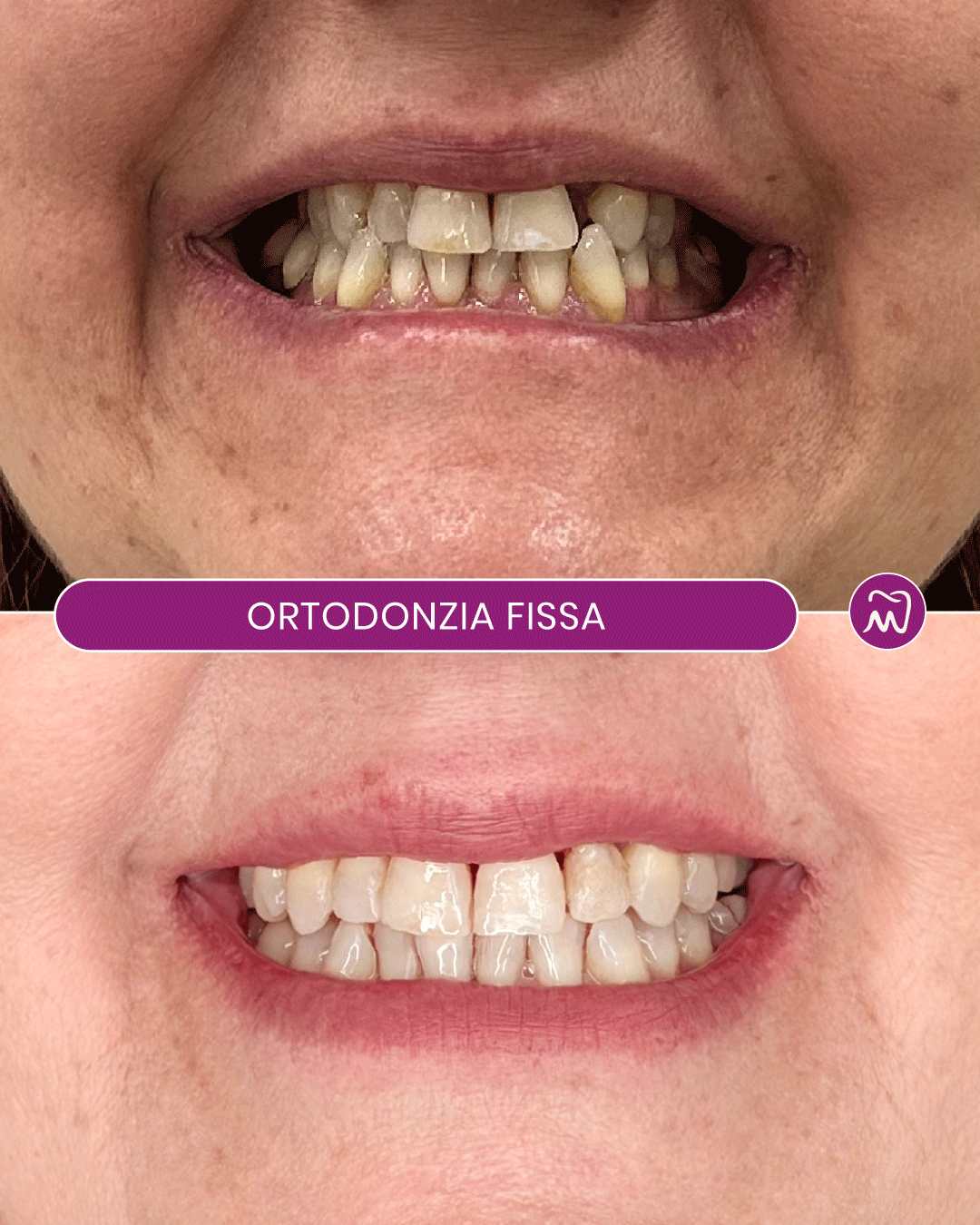 Prima e Dopo Ortodonzia Fissa | Allineamento Dentale Prima e dopo trattamento di ortodonzia fissa per correggere affollamento e disallineamento dentale