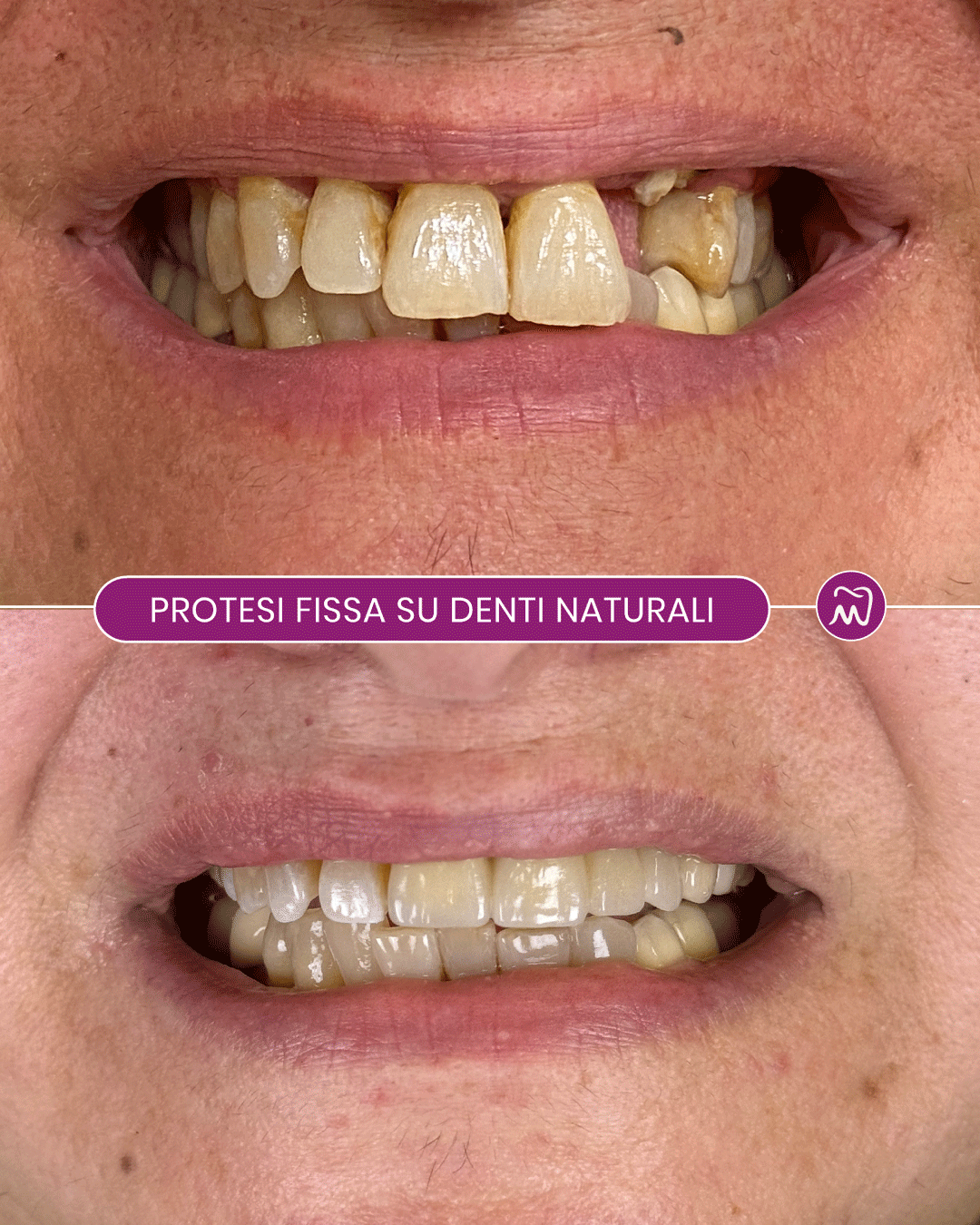 Prima e Dopo Protesi Fissa su Denti Naturali Prima e dopo riabilitazione con protesi fissa su denti naturali per migliorare estetica e funzionalità del sorriso