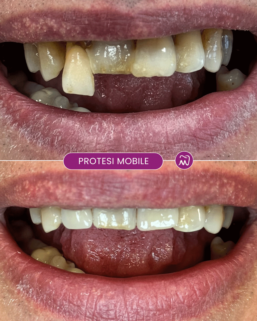 Prima e dopo applicazione di protesi mobile dentale per recupero estetico e funzionale del sorriso