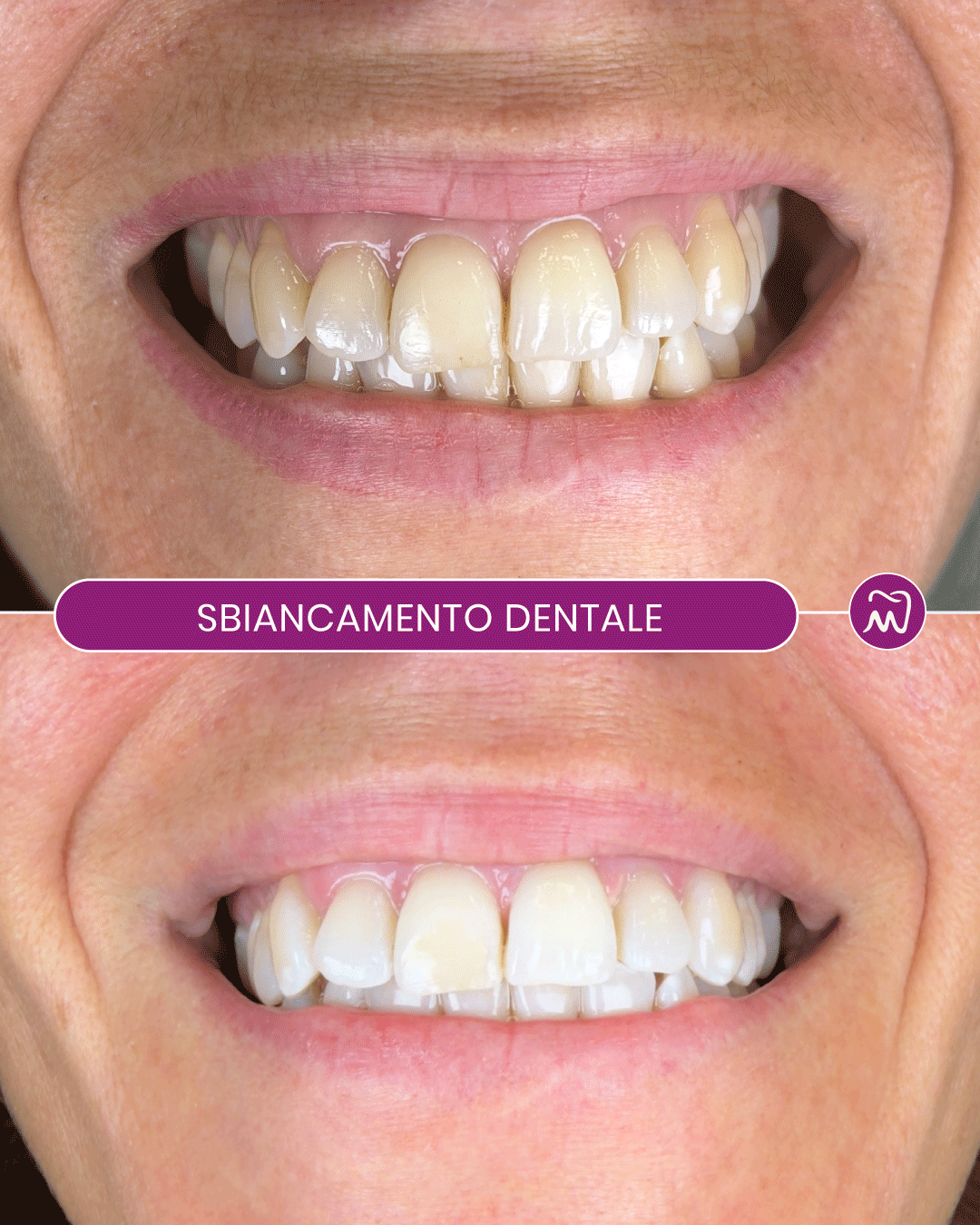 Prima e dopo sbiancamento dentale professionale per migliorare il colore e la luminosità del sorriso