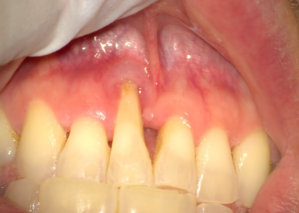 Foto clinica di retrazione gengivale con gengiva ritirata ed esposizione del colletto dentale, utile per spiegare cause, trattamenti e possibili interventi di chirurgia parodontale.