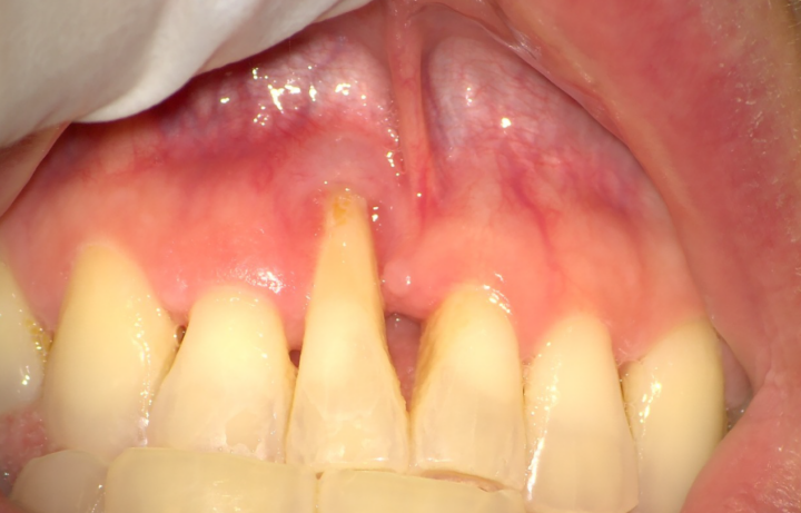 Foto clinica di retrazione gengivale con gengiva ritirata ed esposizione del colletto dentale, utile per spiegare cause, trattamenti e possibili interventi di chirurgia parodontale.