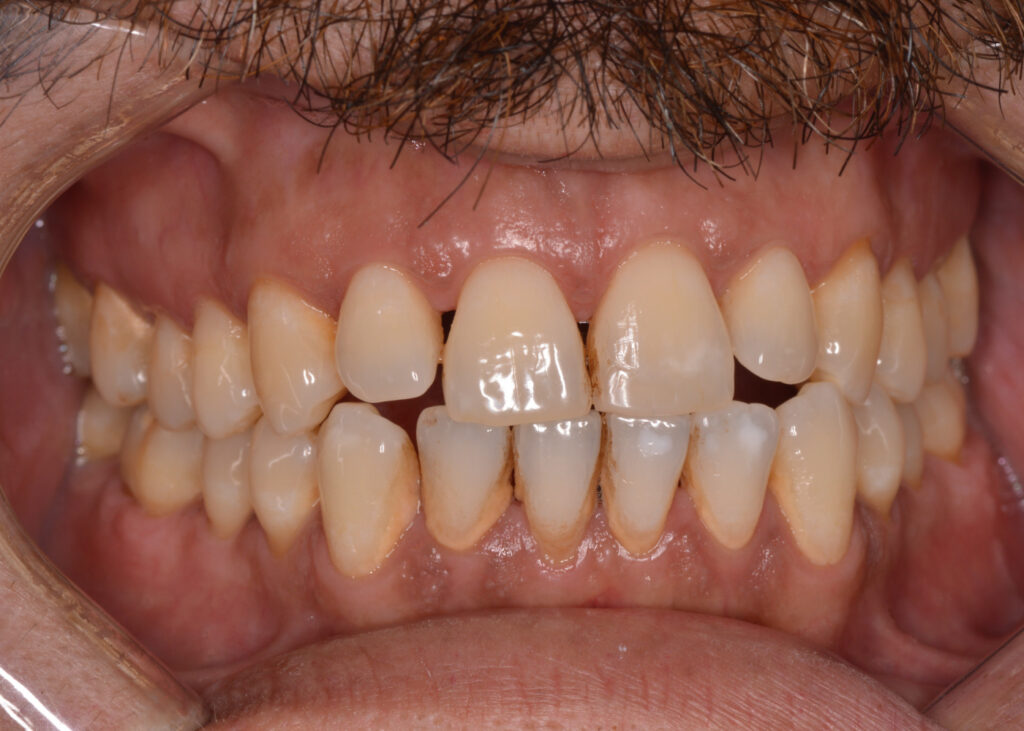 Trattamento della parodontite con terapia laser presso studio dentistico a Napoli
