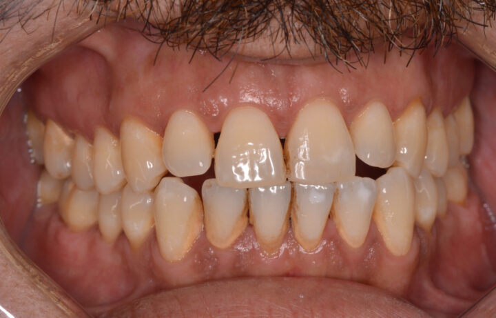 Trattamento della parodontite con terapia laser presso studio dentistico a Napoli