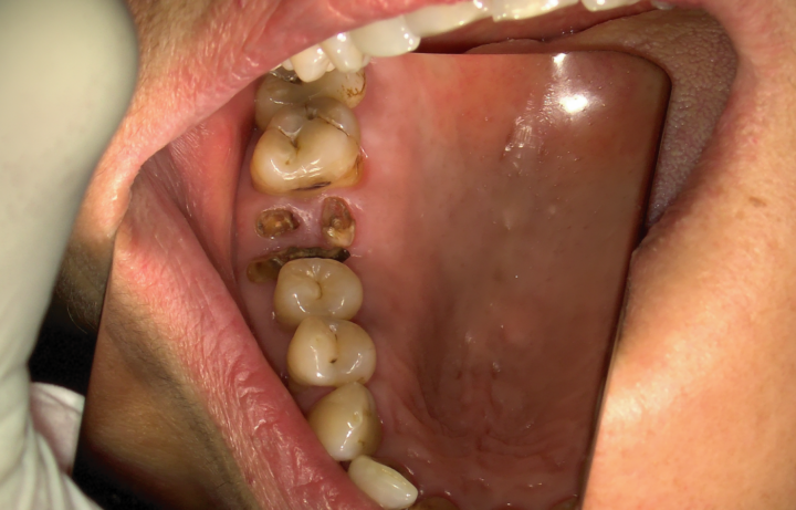 Radici residue di un dente fratturato da estrarre presso dentista a Napoli