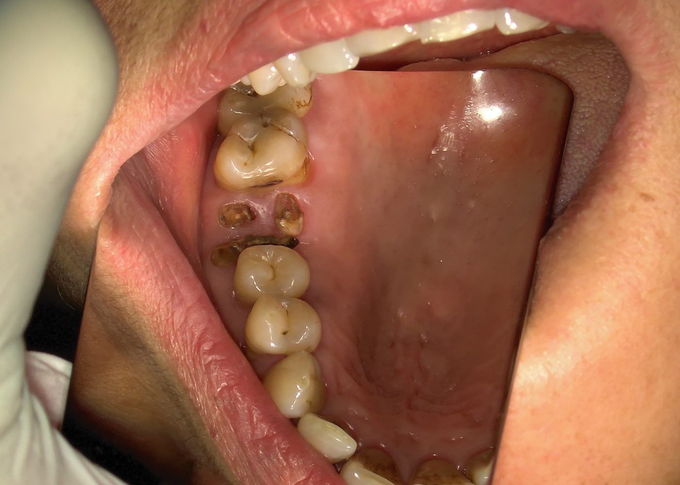 Radici residue di un dente fratturato da estrarre presso dentista a Napoli