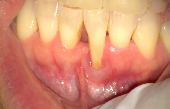 Foto clinica di retrazione gengivale con gengiva ritirata ed esposizione del colletto dentale, utile per spiegare cause, trattamenti e possibili interventi di chirurgia parodontale.