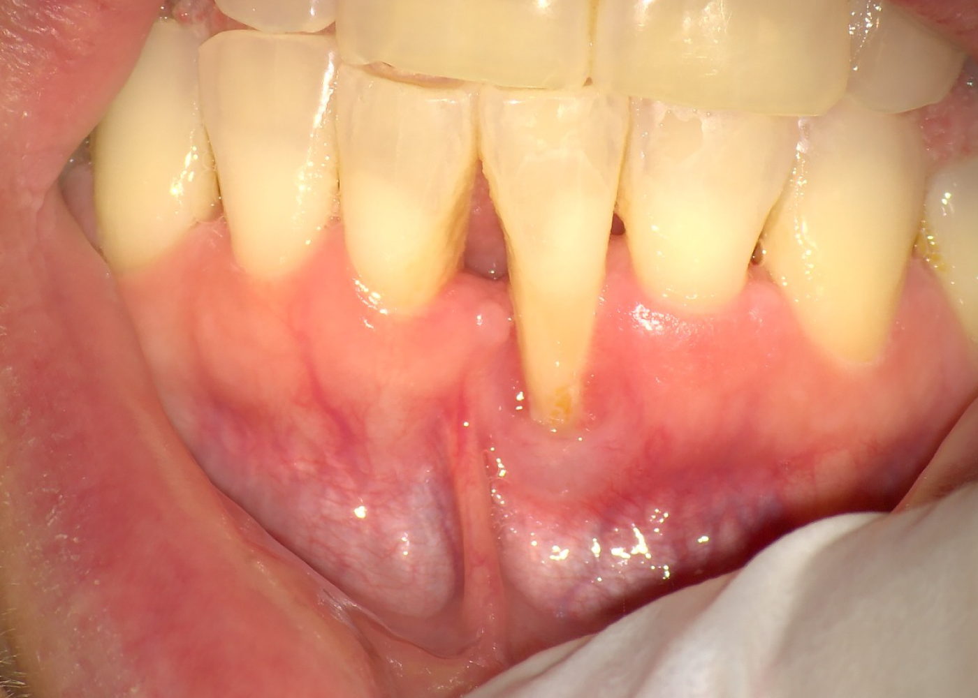 Foto clinica di retrazione gengivale con gengiva ritirata ed esposizione del colletto dentale, utile per spiegare cause, trattamenti e possibili interventi di chirurgia parodontale.