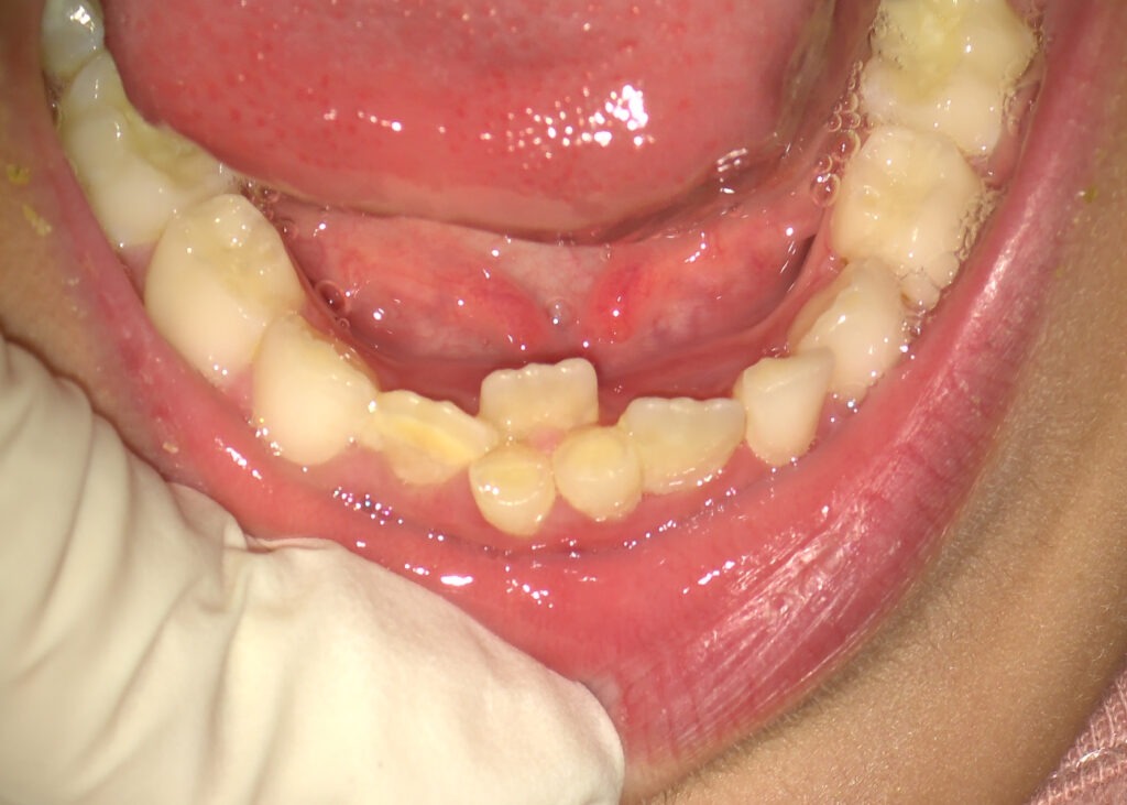 Denti permanenti dietro denti da latte. Dentista per bambini a Napoli
