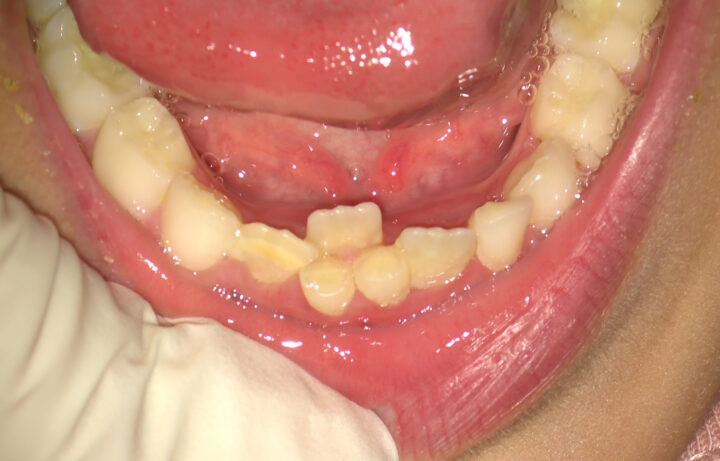 Denti permanenti dietro denti da latte. Dentista per bambini a Napoli