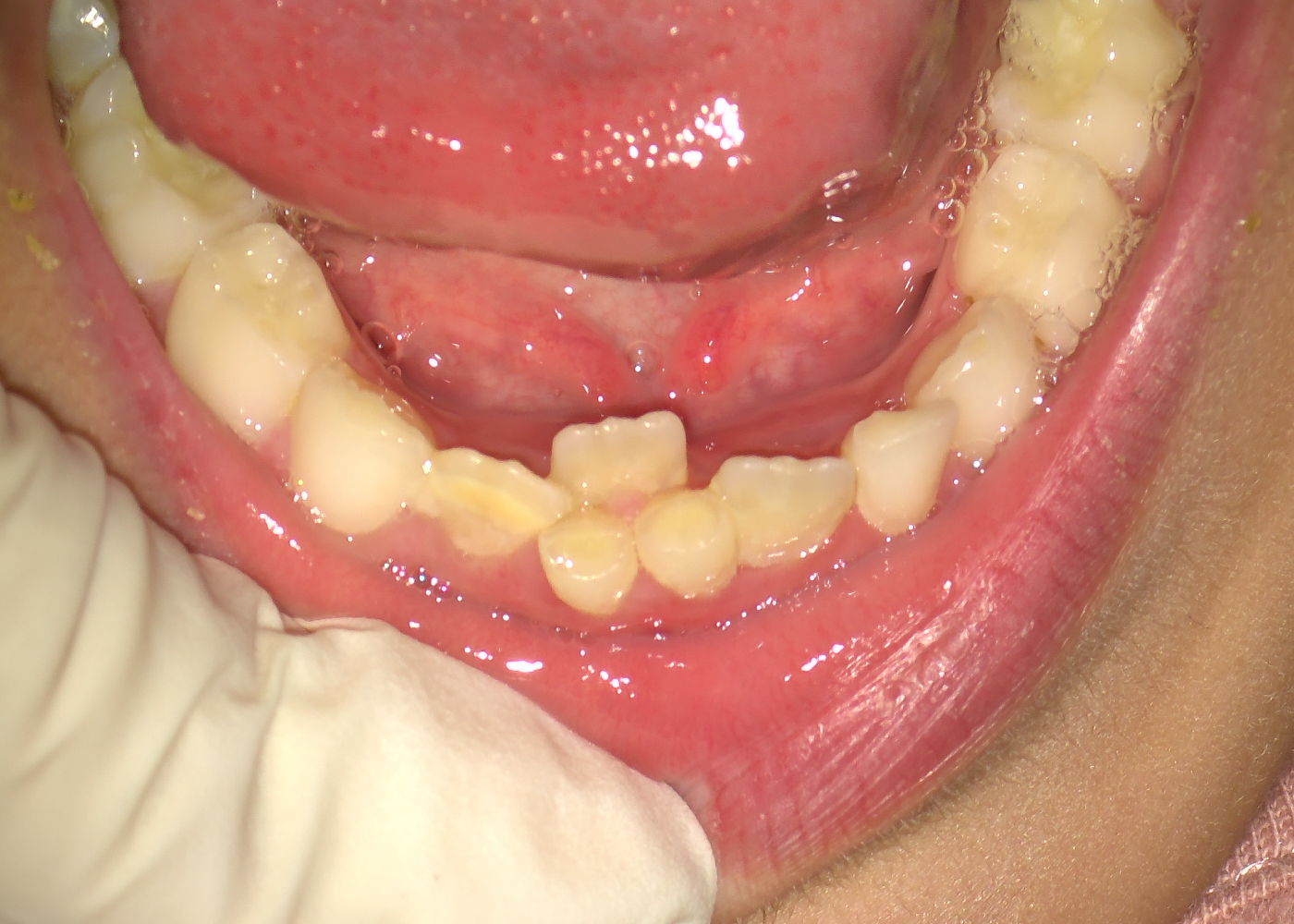 Denti permanenti dietro denti da latte. Dentista per bambini a Napoli