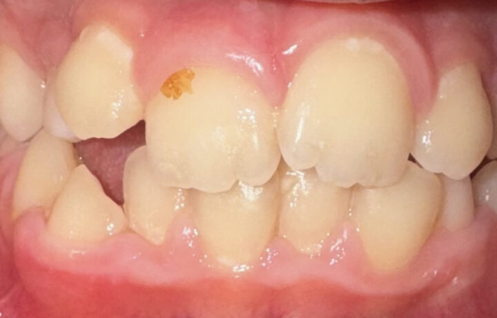 Dentatura di un bambino con disallineamento dentale per valutazione ortodontica a Napoli