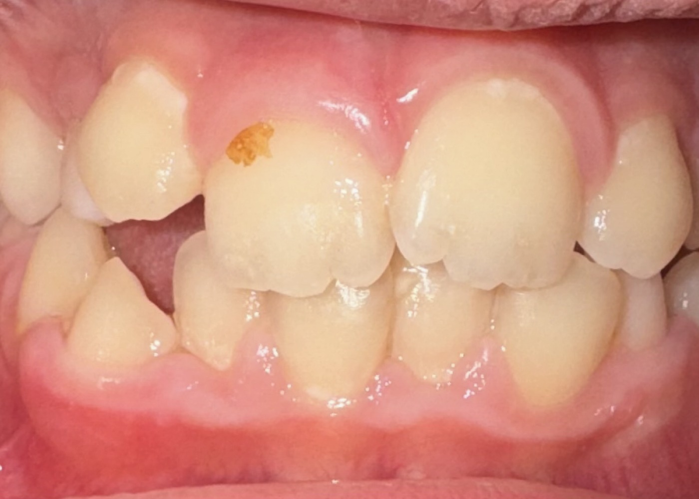 Dentatura di un bambino con disallineamento dentale per valutazione ortodontica a Napoli