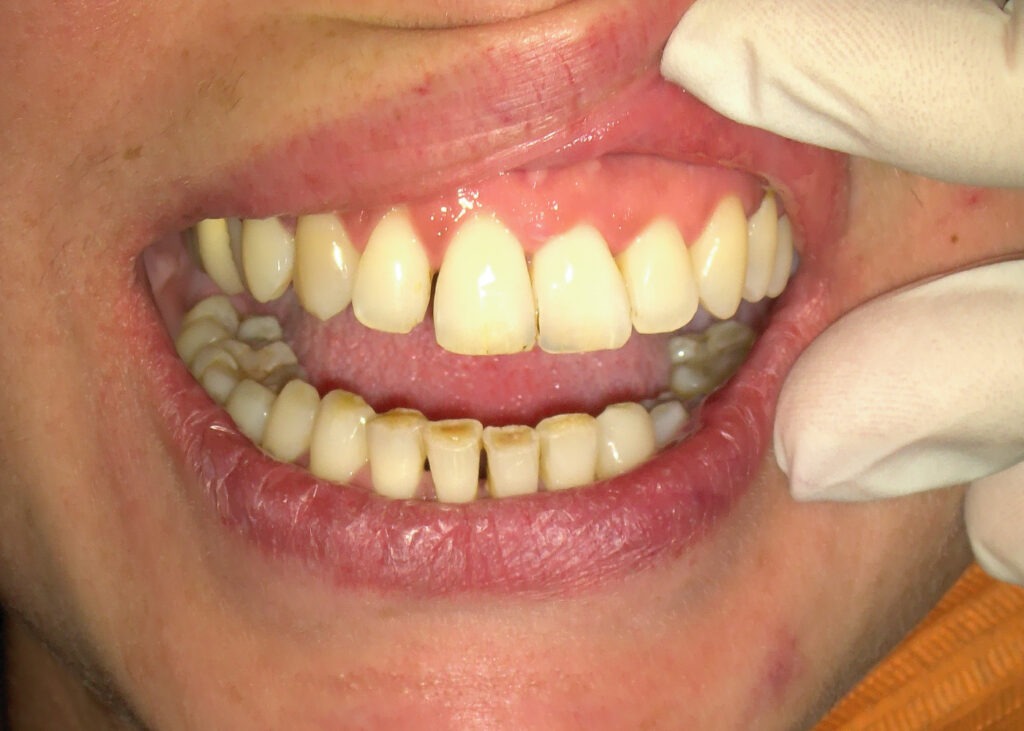 Segni di usura dentale compatibili con bruxismo in paziente a Napoli