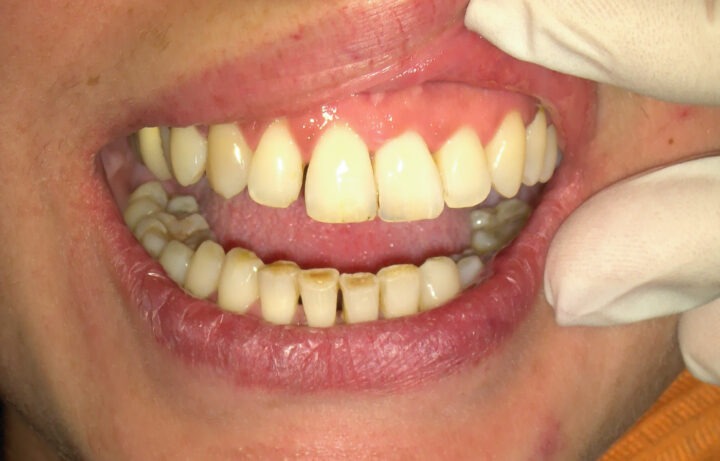 Segni di usura dentale compatibili con bruxismo in paziente a Napoli